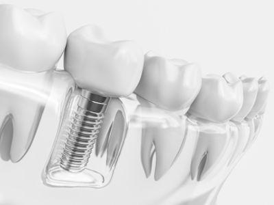 Implantologie | smileDentity - Spezialisten für Zahnimplantate