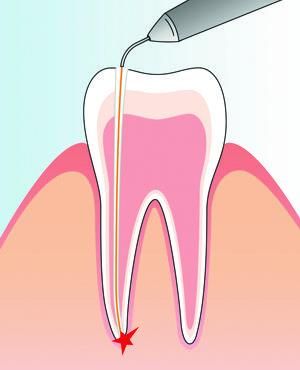 Root canal treatment with laser