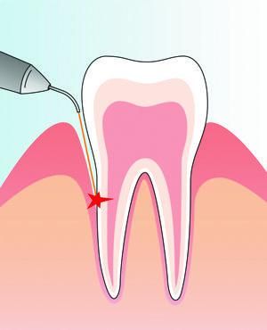 Periodontitis therapy with laser
