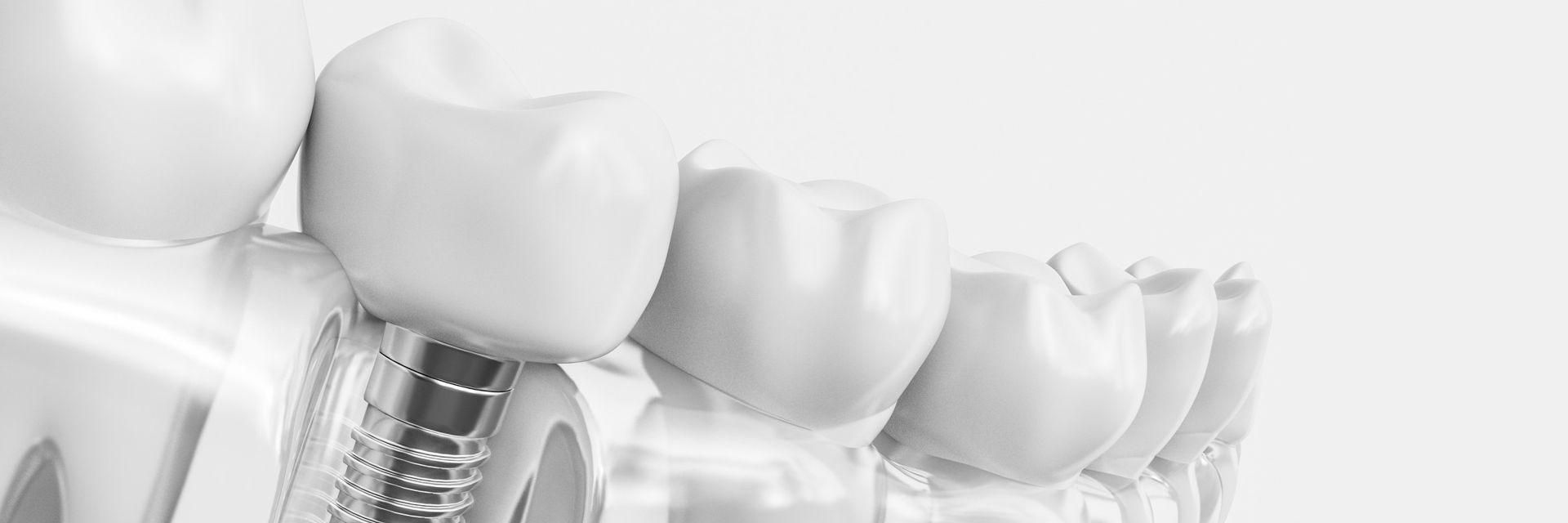 Implantology | smileDentity - specialists for dental implants