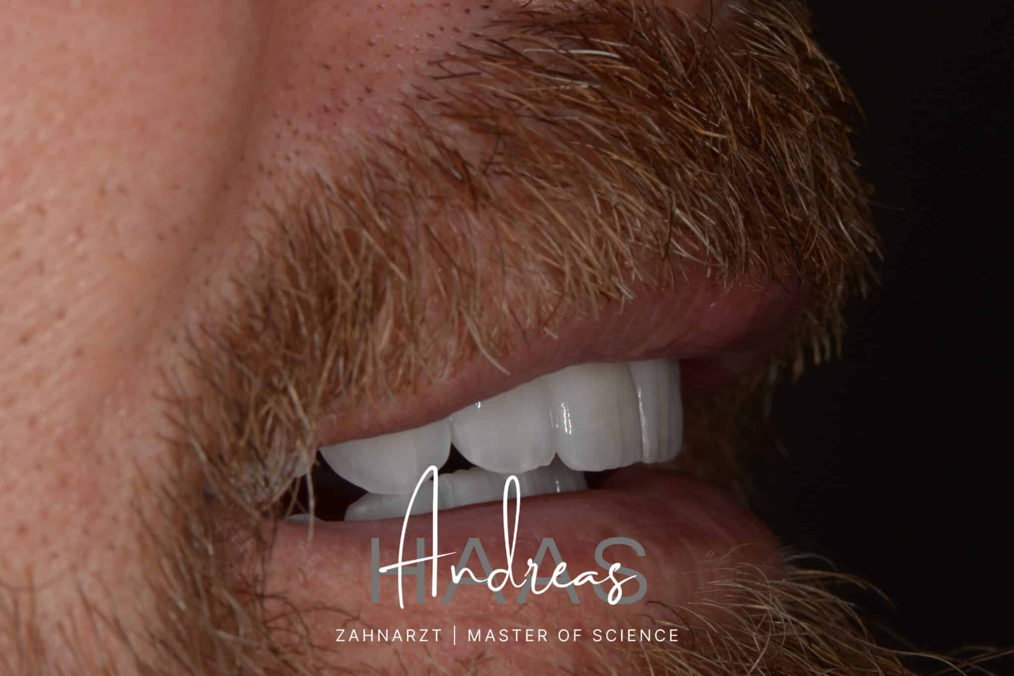 Behandlungsfall nach vollkeramischer Versorgung bei einem Patienten – smileDentity Dreieich