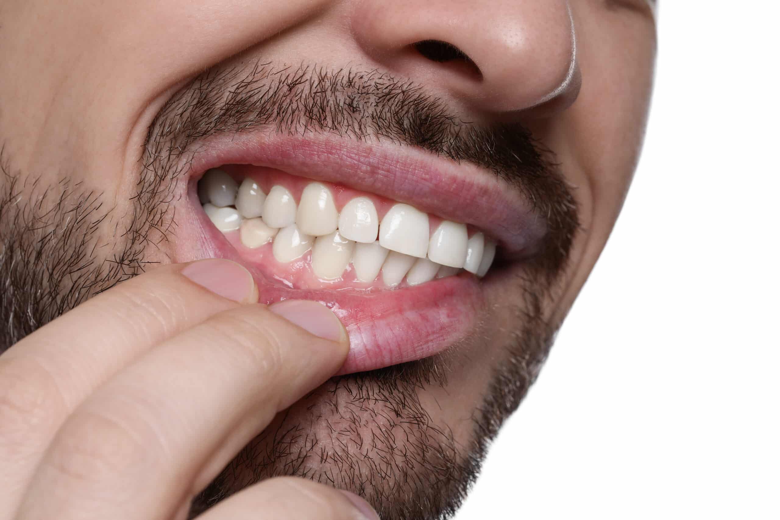 Patient zieht die Lippe herab und zeigt sein Zahnfleisch — Schwellungen als Warnsignal einer Entzündung