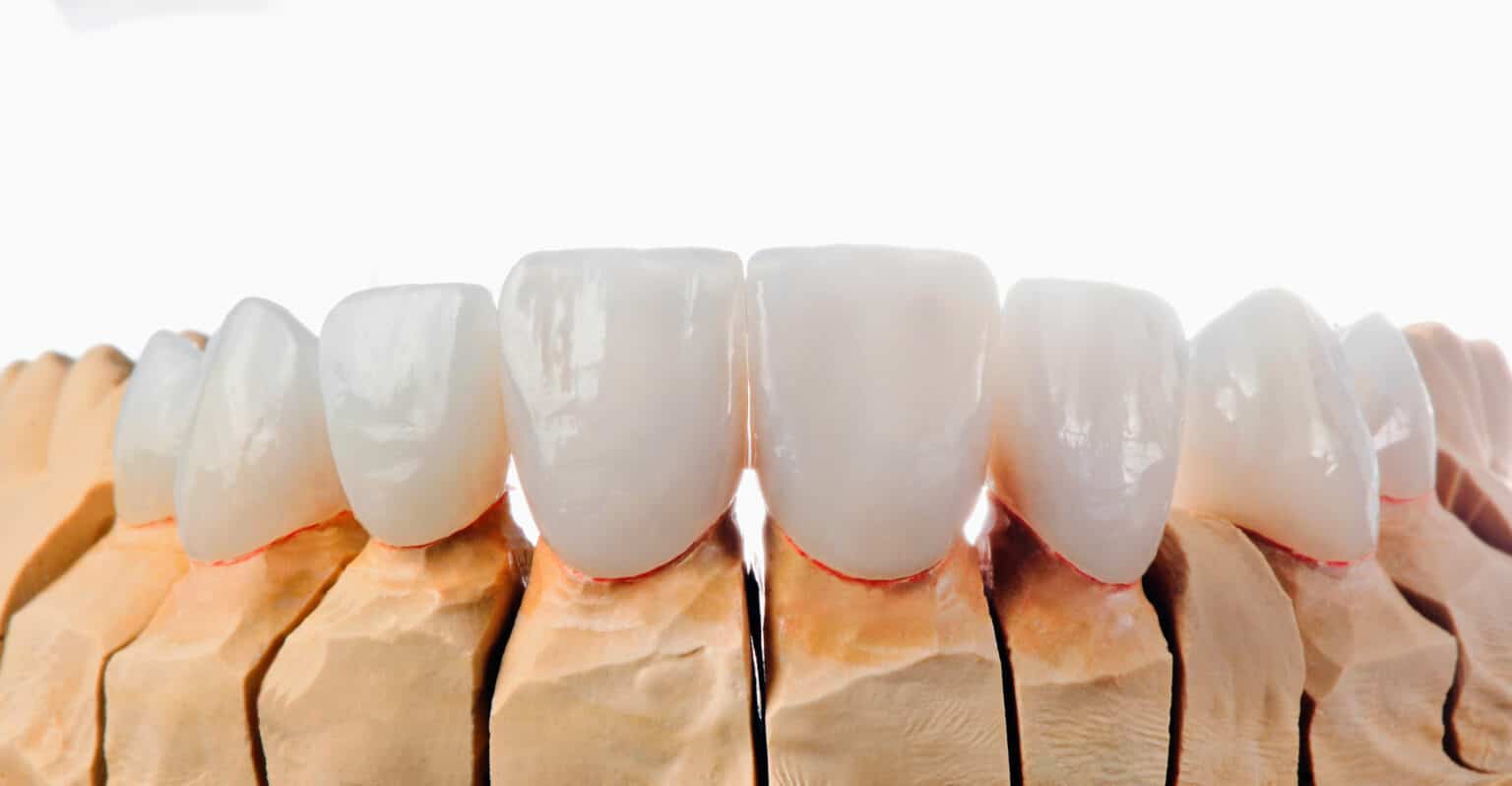 Veneers – smileDentity Dreieich